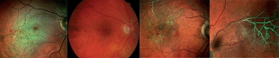 Retinal Screening