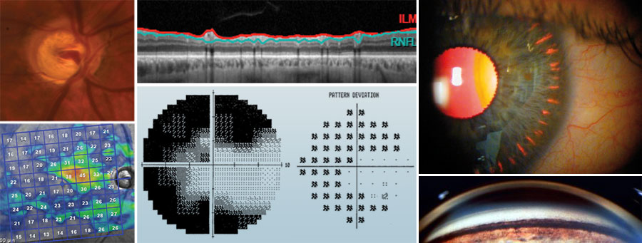 Glaucoma Management