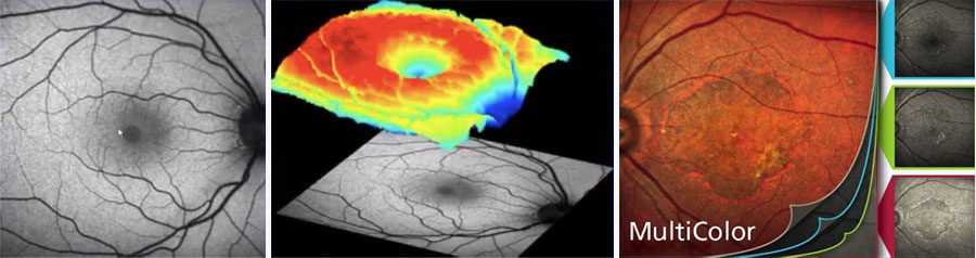 Retinal Screening