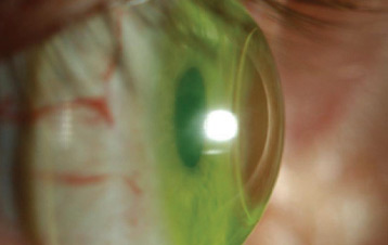 Complex Contact Lenses