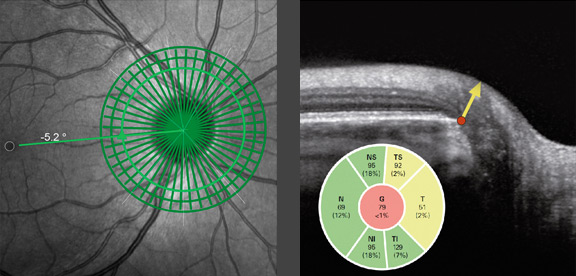 Glaucoma Management