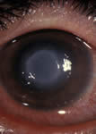 Does Your Contact Lens Solution Kill Acanthamoeba?