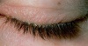 Blepharitis: What Type do You Have?